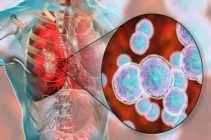 Infecciones causadas por Pseudomonas aeruginosa