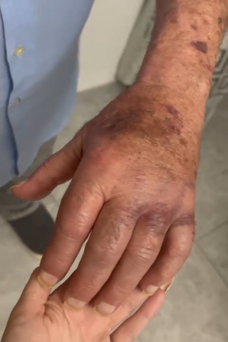 Heridas sufridas en la mano por el anciano agredido